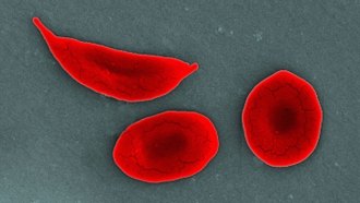 Two normal red blood cells are shown next to a curved, sickled blood cell